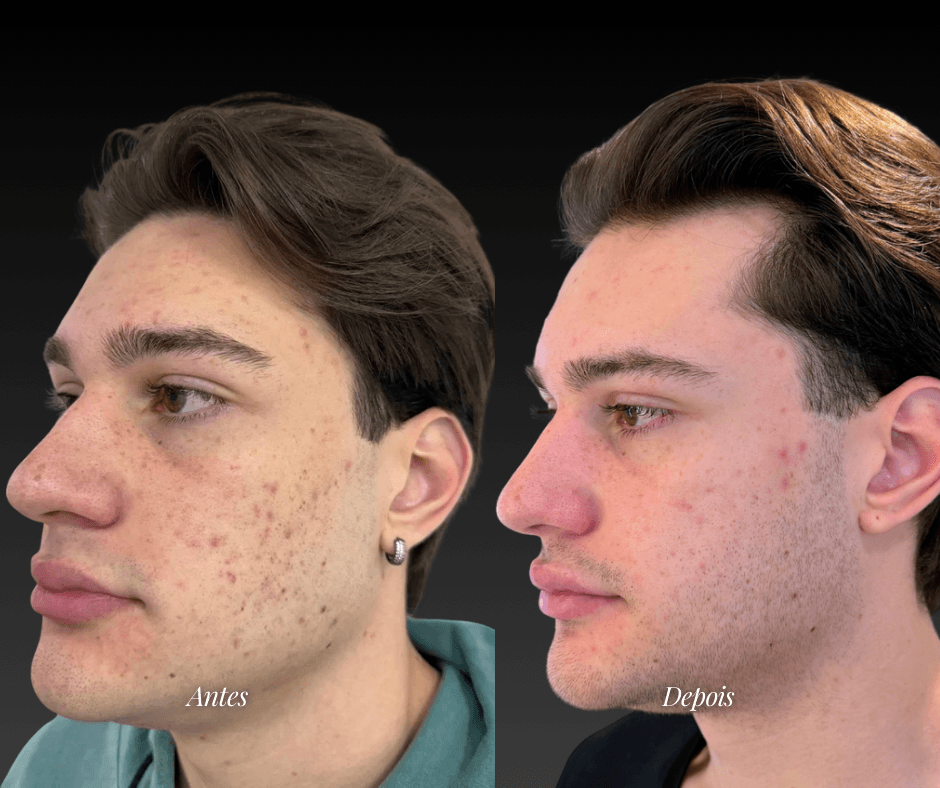 Skin Glass — antes e depois