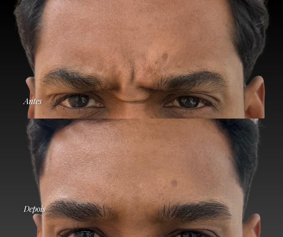 Toxina botulínica na glabela — antes e depois