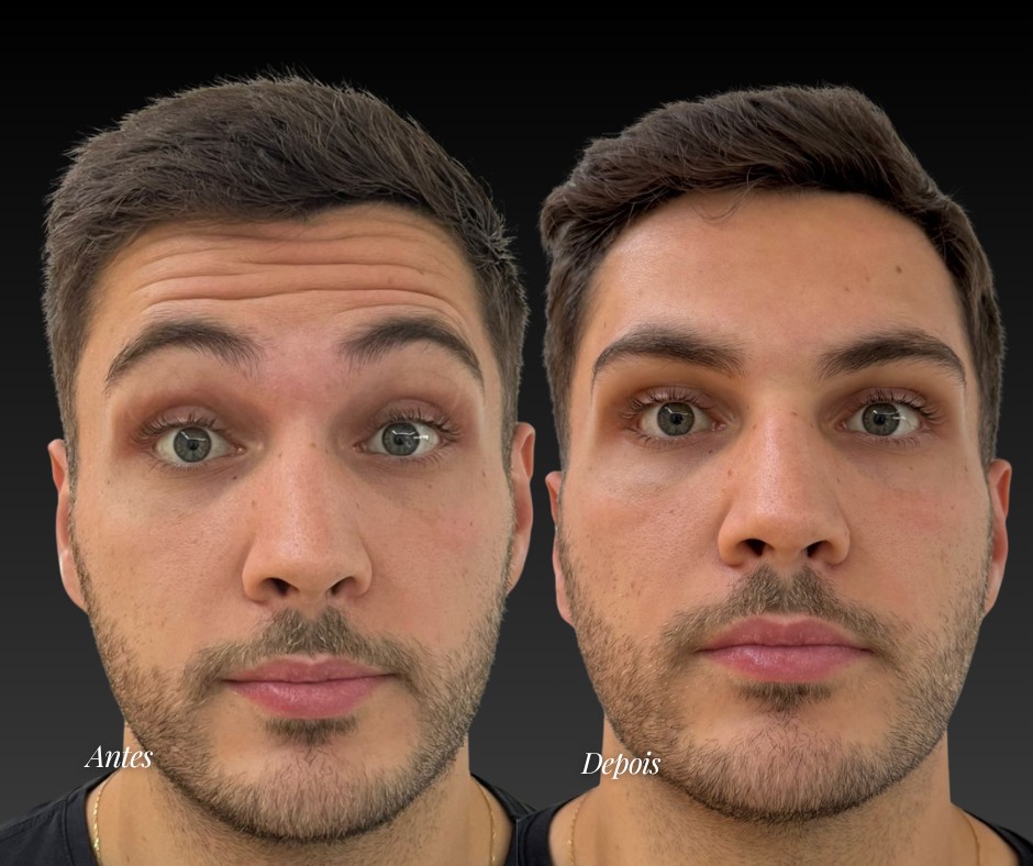 Toxina botulínica — antes e depois