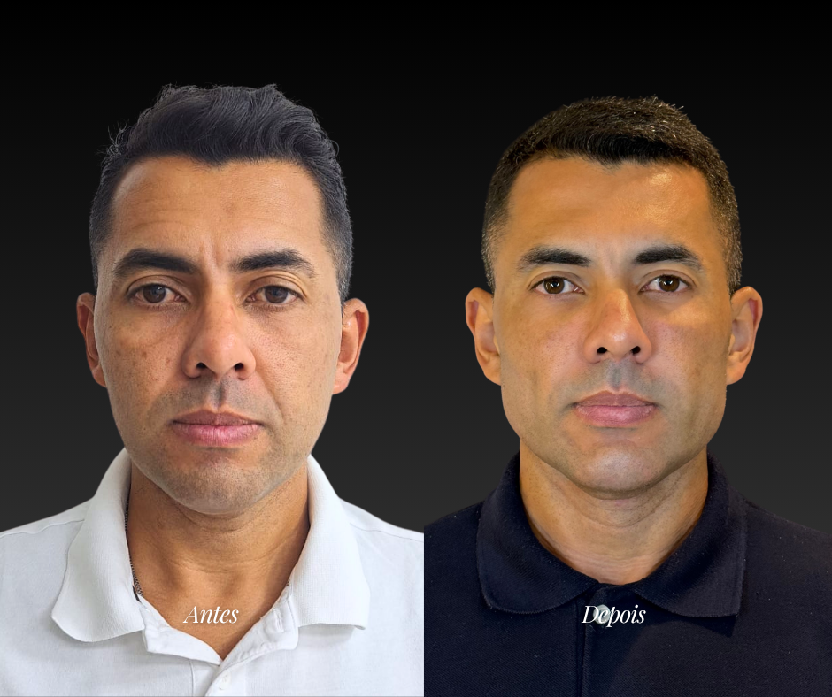 Harmonização facial masculina — antes e depois