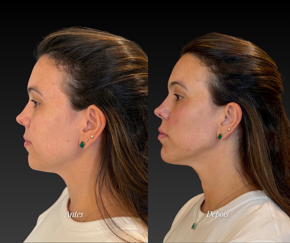 Harmonização facial feminina — antes e depois