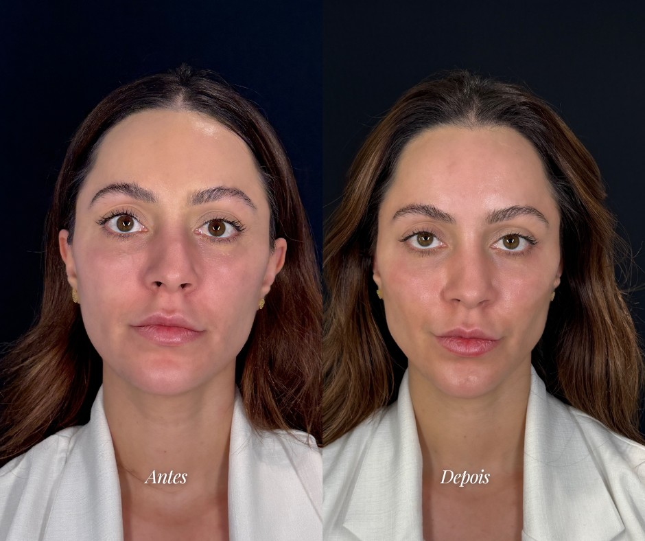 Harmonização facial fullface — antes e depois