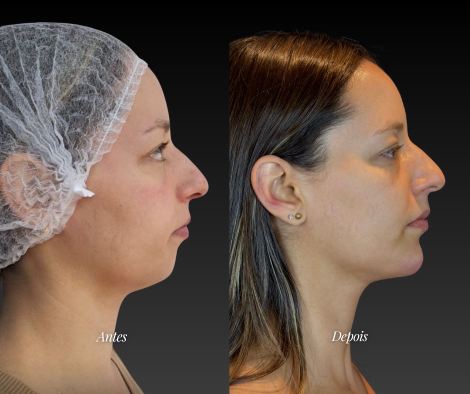 Harmonização facial com mento — antes e depois