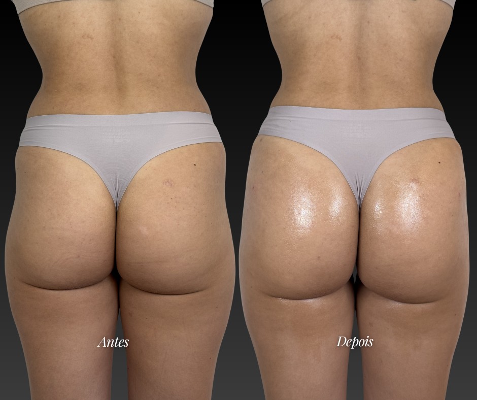 Harmonização glútea — antes e depois