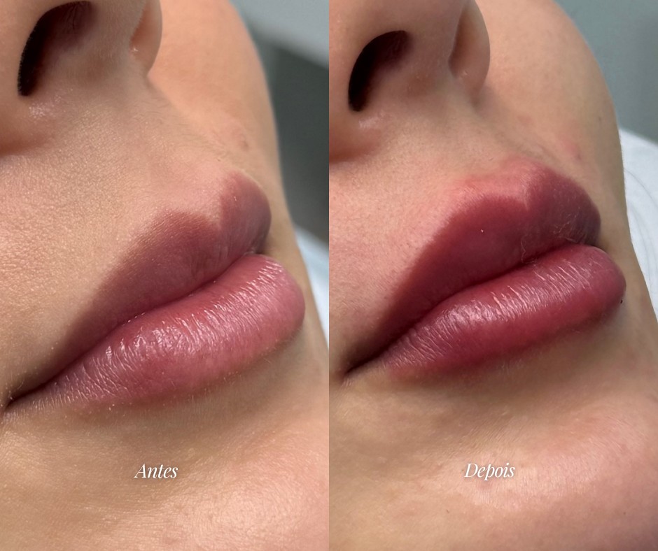 Preenchimento labial — antes e depois