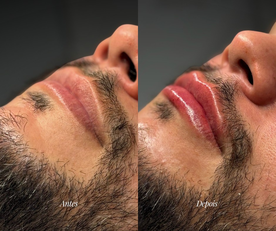 Preenchimento labial masculino — antes e depois