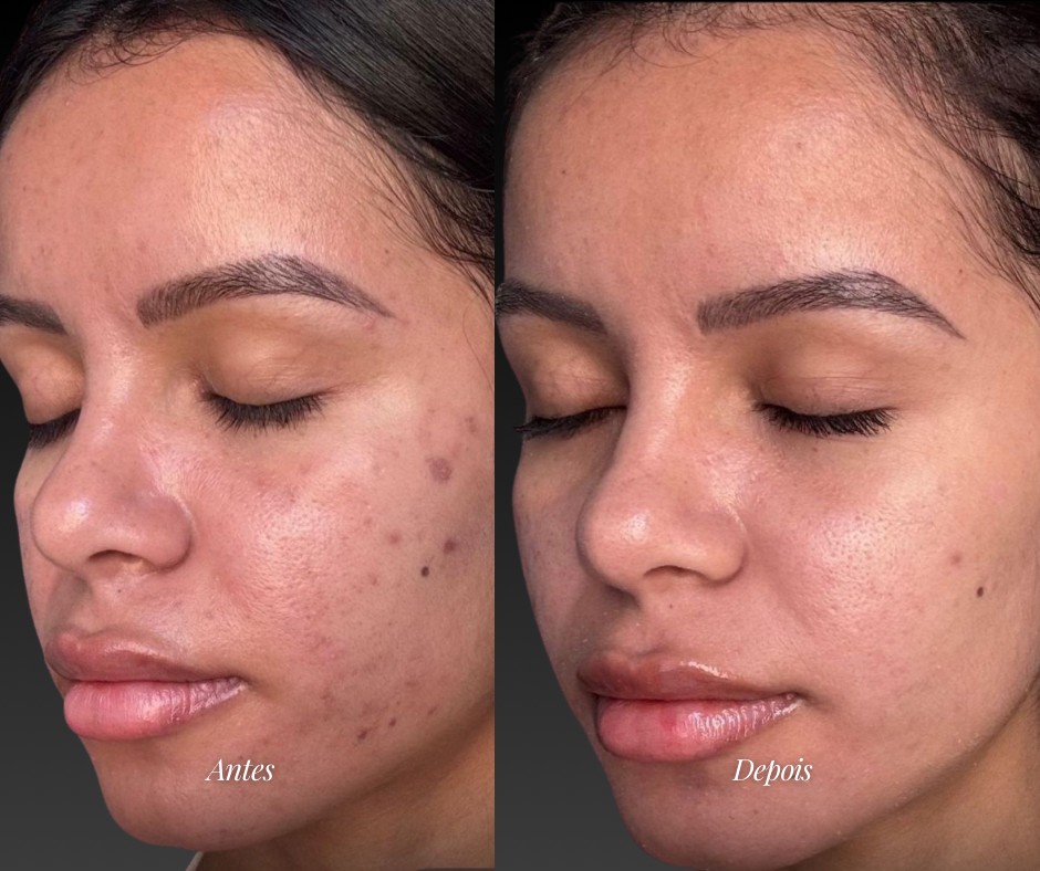 Skin Glass / protocolo de pele — antes e depois